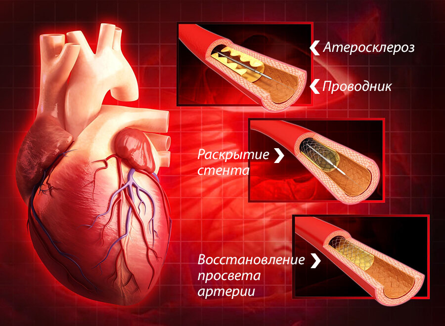 Памятка пациенту, перенесшему стентирование коронарных артерий