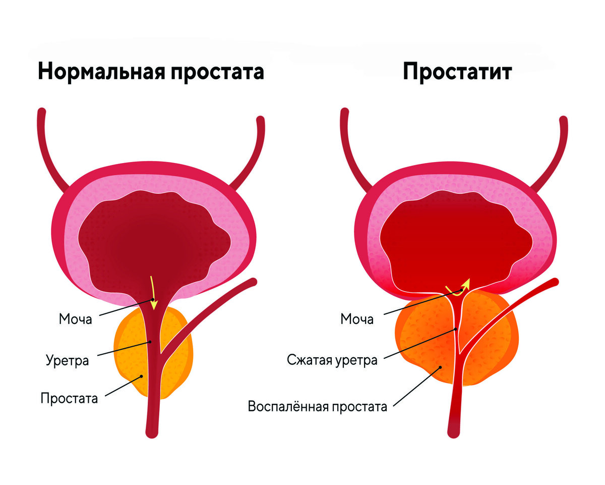 Бактериальная простата. Бактериальная простата