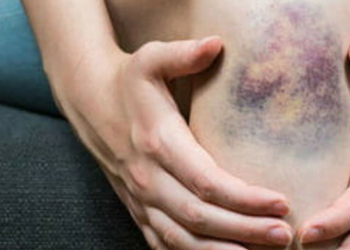 Синяк и ушиб