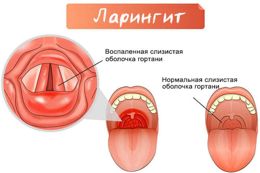 Ларингит у ребенка лечение. Воспаление слизистой оболочки гортани - ларингит. Острый катаральный ларингит. Тонзиллиты фарингиты ларингиты. Гиперпластический фарингит.