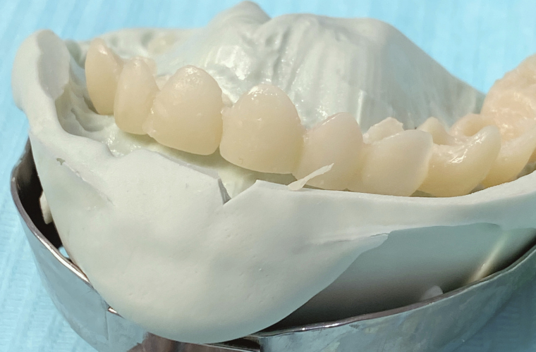 Временные зубы из пластмассы, которые установят на время изготовления протеза