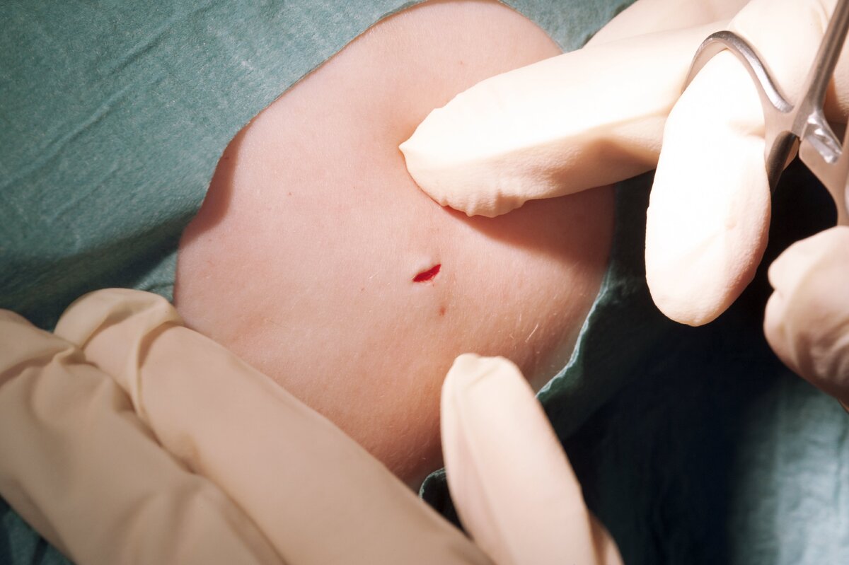    Гормональный имплант извлечениеLegion Media