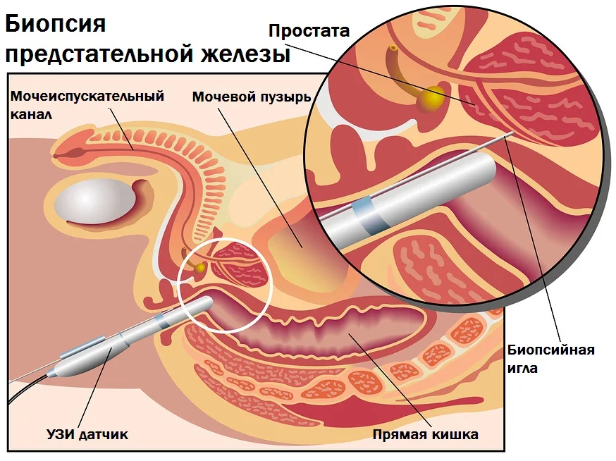 Биопсия предстательной железы. Трансректальная биопсия. Трансректальная биопсия простаты. Эндоректальная катушка мрт. Трансперинеальная биопсия предстательной железы