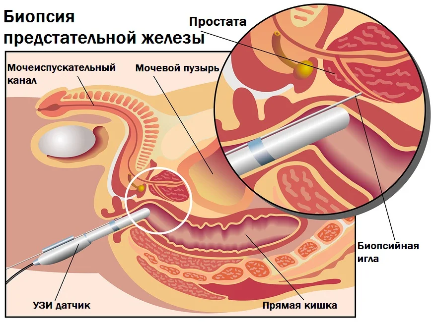 Как делается биопсия предстательной железы фото