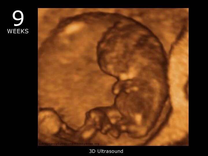 УЗИ-снимок 8-9 недели беременности