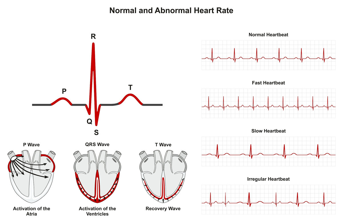 Норма форма сердца. Сердечный ритм на ЭКГ норма. ЭКГ при тахикардии и брадикардии. Брадикардия на ЭКГ при аритмии. Синусовая брадикардия схема ЭКГ.