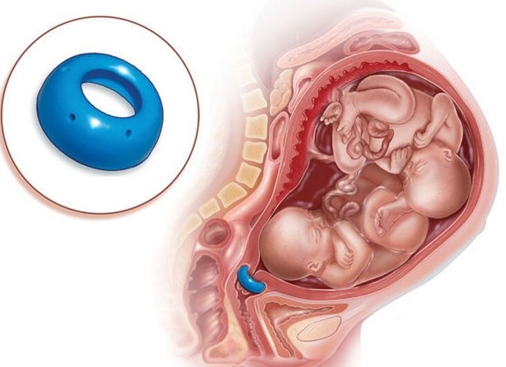 Промывка пессария — 22 ответов | форум Babyblog