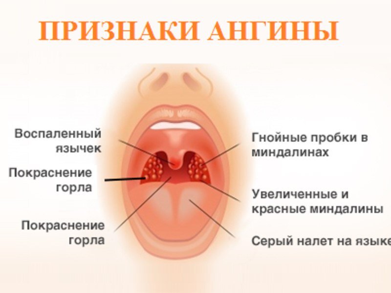 Ангина — Надежда Игошина Голая