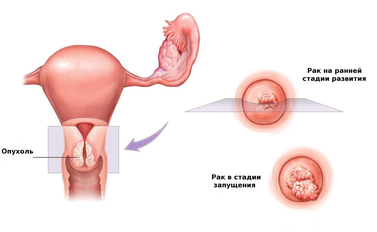 Рак шейки матки. Источник "Яндекс Картинки"