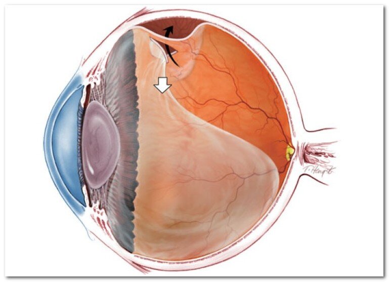 Отслоение сетчатки