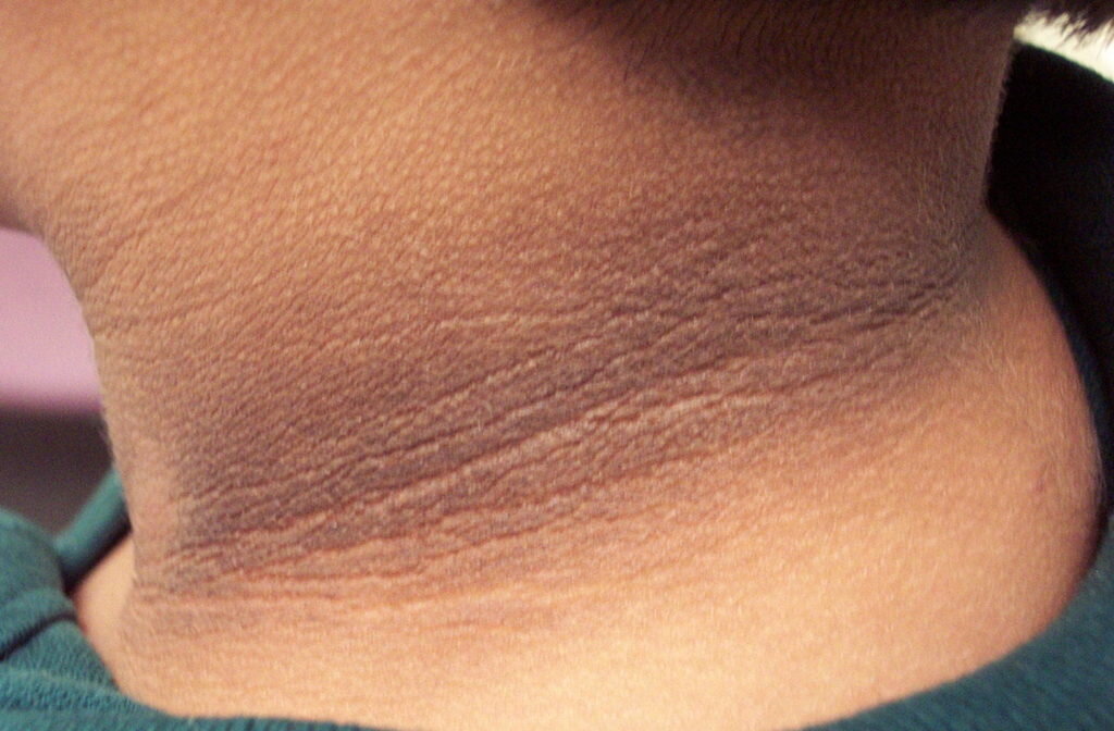 Кожная складка. Черный акантоз (acanthosis nigricans).