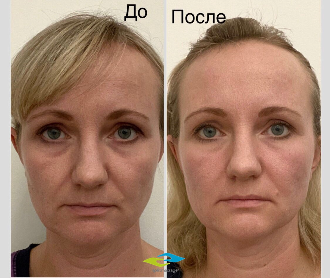 Результаты процедуры Сплитмассаж
