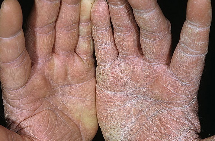 Сухая кожа рук – лечение в Кривом Роге ксероза и дерматитов