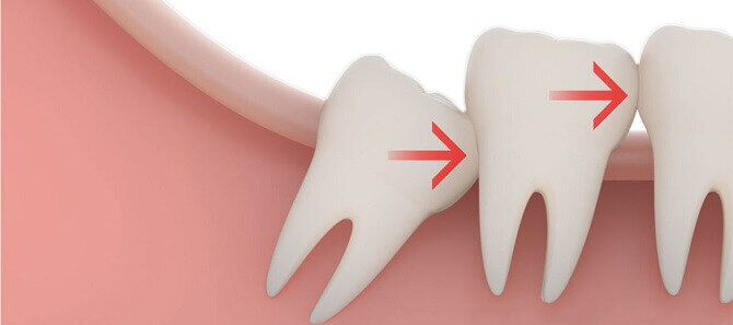 Дистопированный зуб давит на соседей, вызывая их смещение