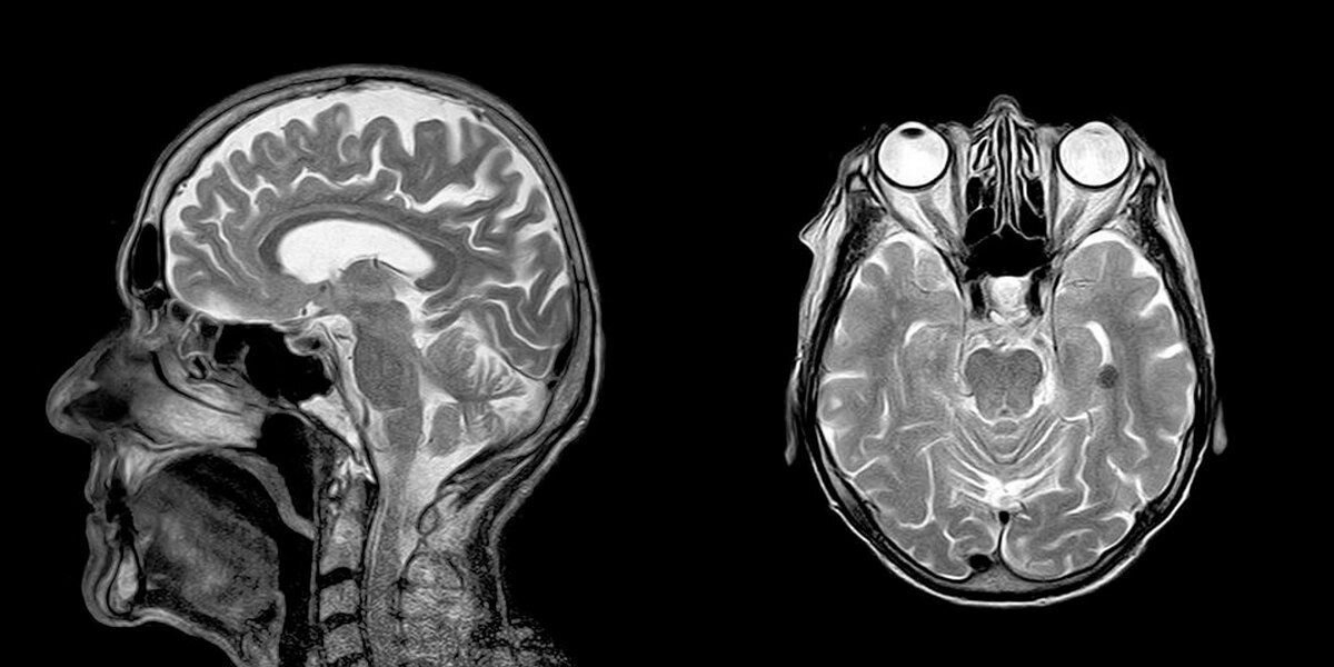 Мрт паническая атака. Магнито-резонансная томография головного мозга. Кт томограмма головного мозга. Магнитно резонансные томограммы головного мозга. Головной мозг на кт-томографии.