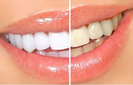 Идеальная улыбка - мечта для многих, но как же отбелить зубы в домашних условиях быстро, знает не каждый. Добиться отличных результатов в качественном осветлении зубной эмали совсем несложно, существуют современные безопасные методы отбеливания зубов, которые не требуют существенных материальных затрат и займут минимум времени. Лондонские стоматологи считают, что белизна эмали должна примерно совпадать с цветом белка наших глаз. Не забывайте консультироваться у специалистов ,перед применением любых манипуляций со здоровьем!