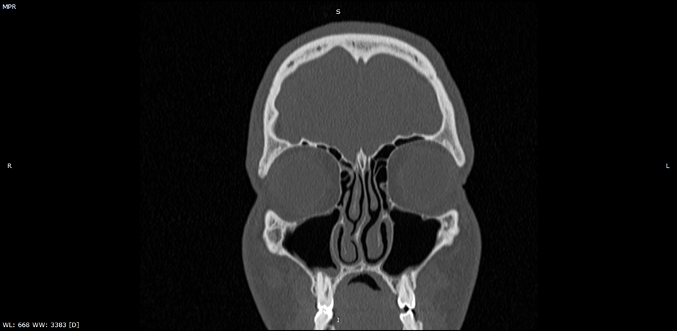 Компьютерная томография придаточных пазух носа, фронтальная реконструкция