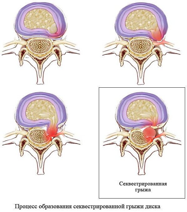 Секвестрация грыжи