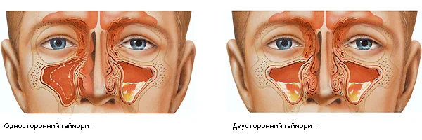 Основная причина боли в зубах при гайморите