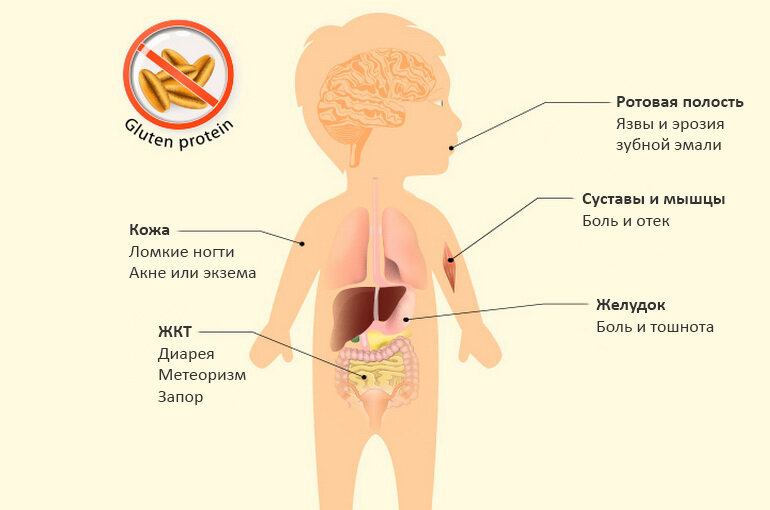 Алергия на глютен