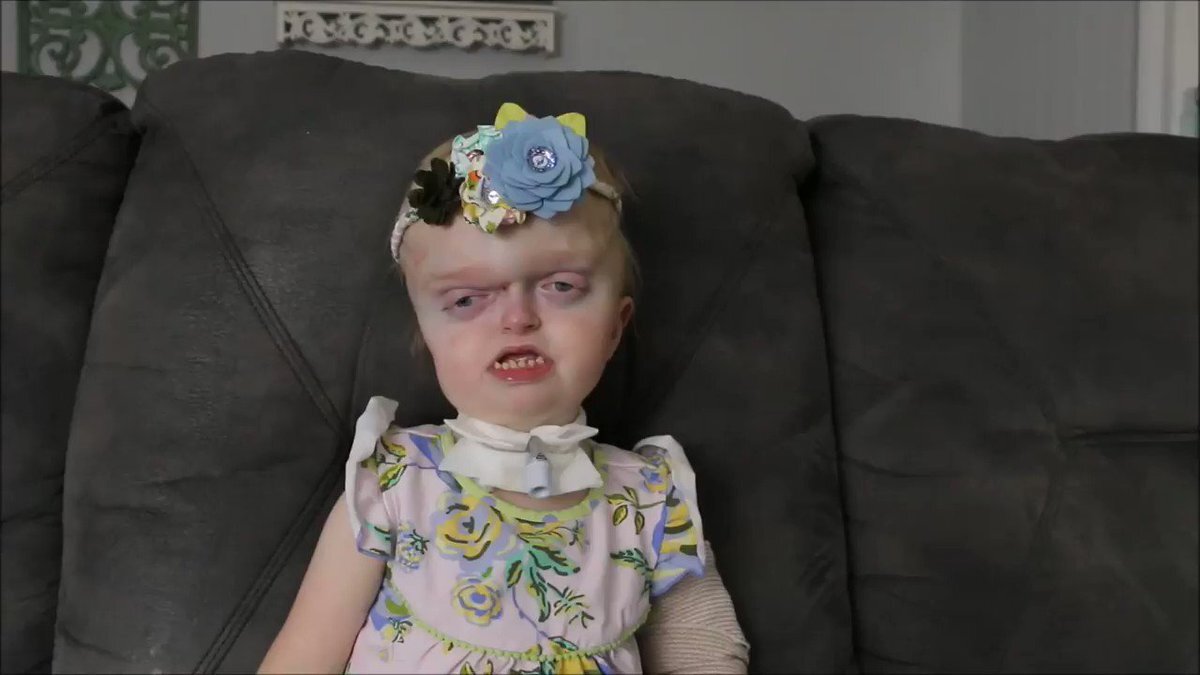 Ребенок с синдромом Пфайффера