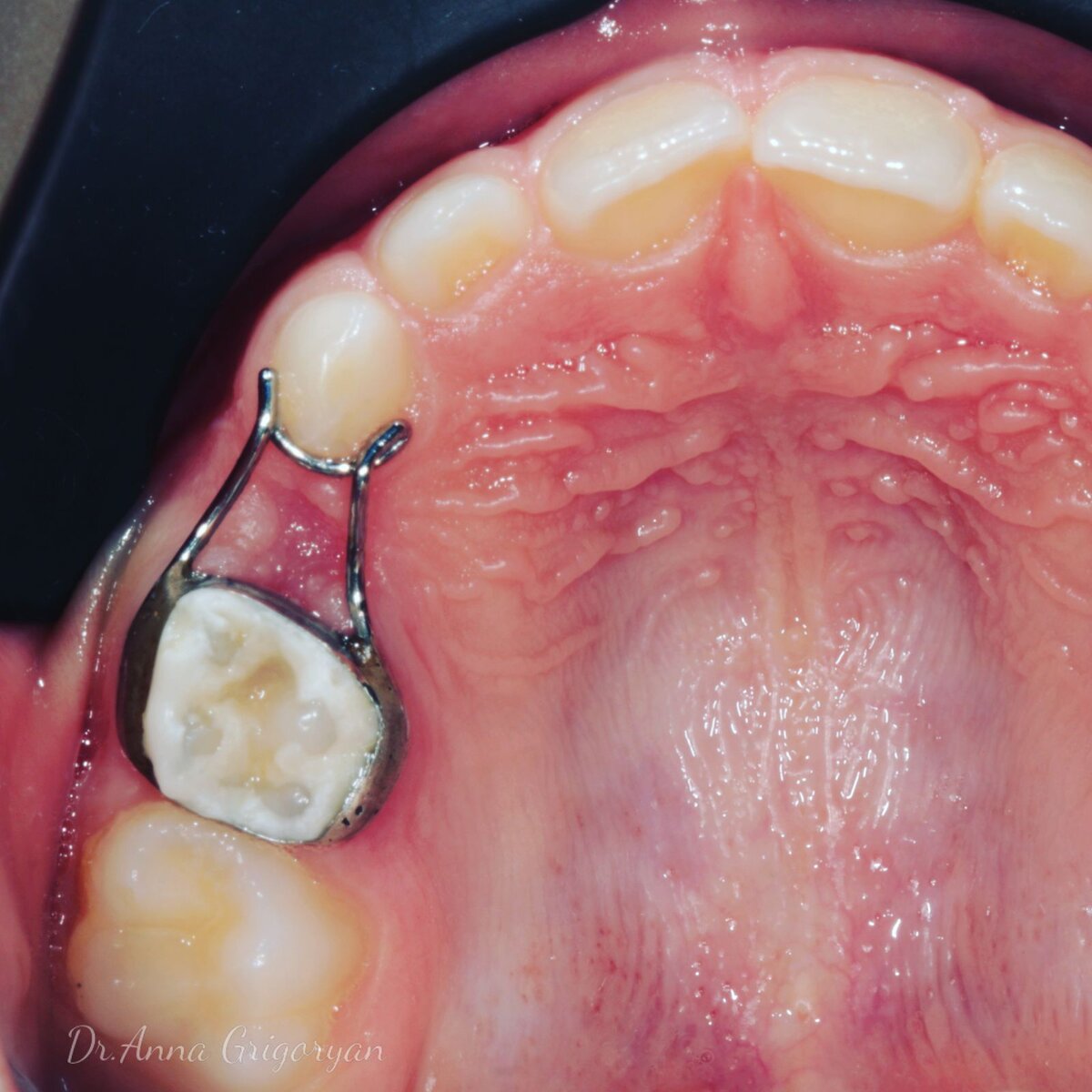 Кольцо-петля