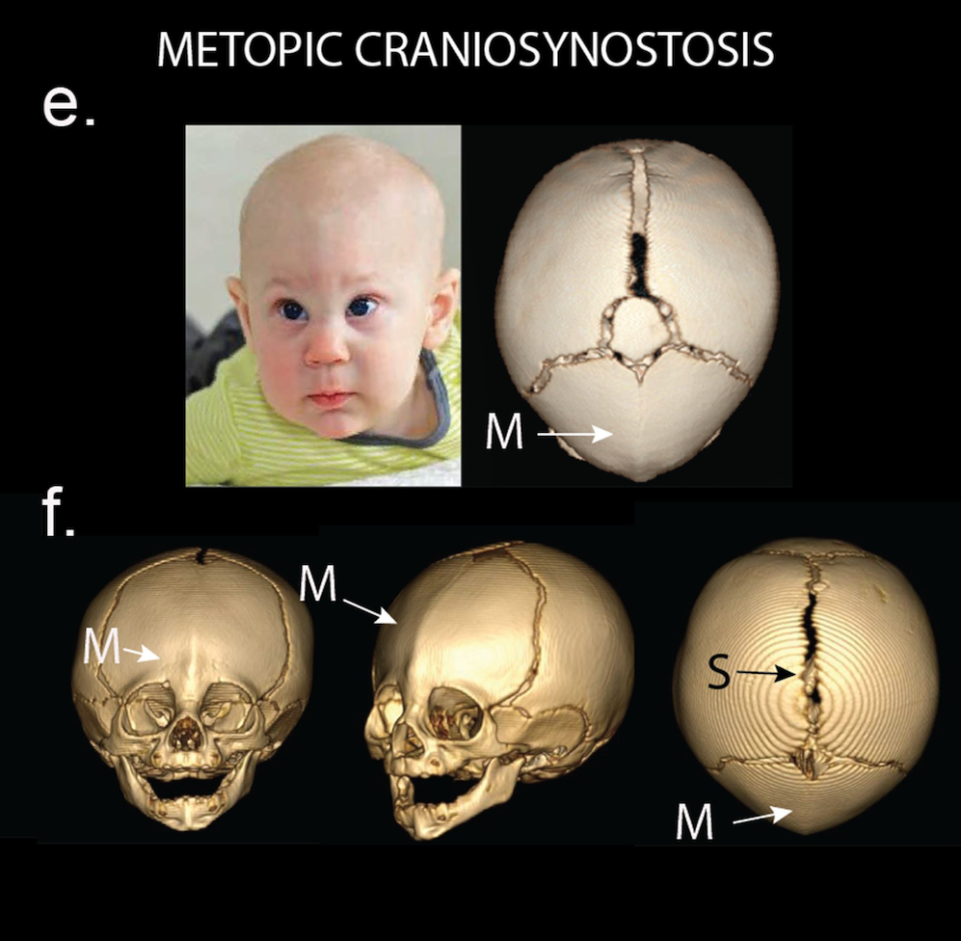 Краниосиностоз плагиоцефалия. Сагиттальный краниосиностоз скафоцефалия. Сагиттальный шов краниостеноз. Метопический краниосиностоз у ребенка. Череп малыша