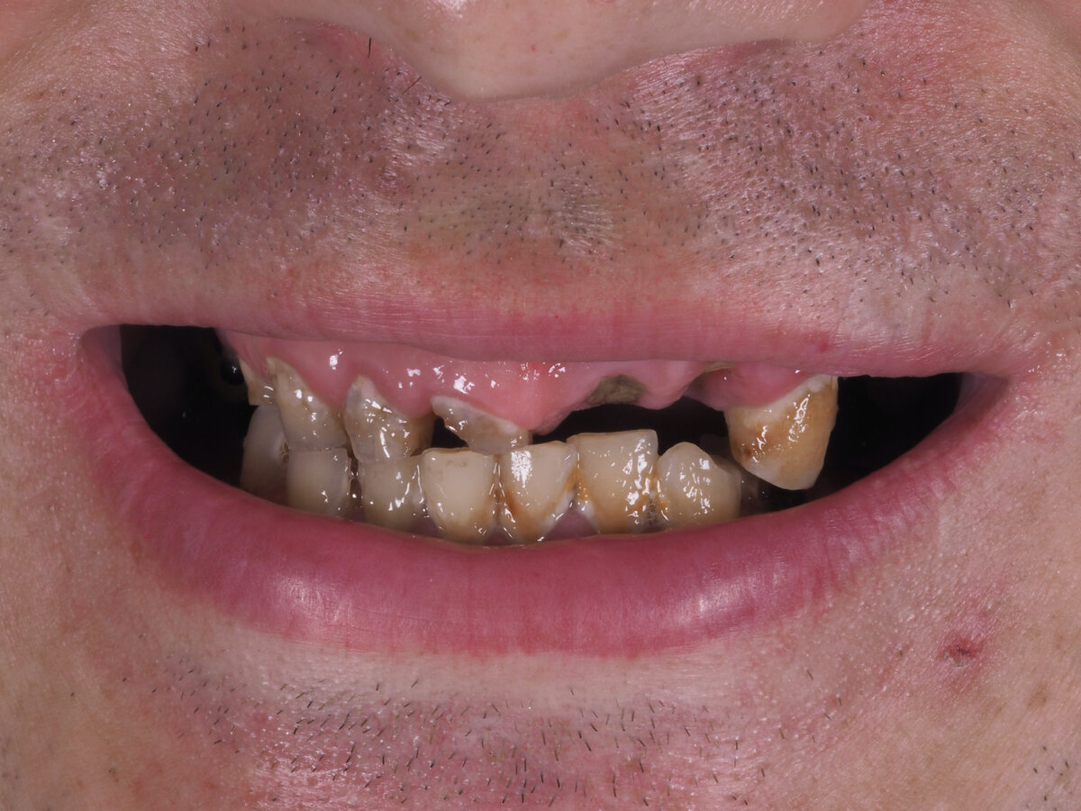 Пациент жаловался на отсутствие зубов, вторичная деформация зубных рядов ( на фото наглядно видно как поднялся уровень нижних резцов до десны верхней челюсти). Прием пищи при такой клинической ситуации был очень сложен для пациента. 