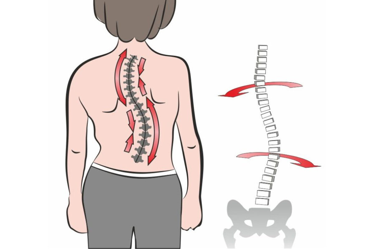 Позвоночник при сколиозе картинка