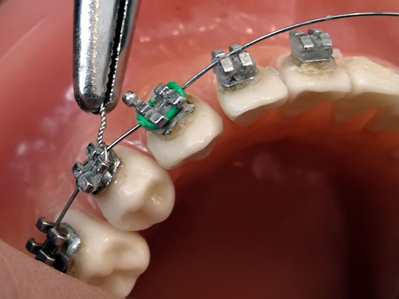 Что ставится на зубы. Ортодонтия в стоматологии. Лигатура ортодонтическая. Фиксация брекет системы.