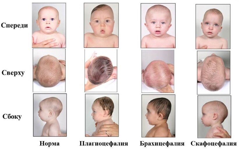 Затылок норма. Форма головы сбоку младенца. Форма черепа у детей до года правильная. Кривошея плагиоцефалия. Правильная форма головы у грудничка 3 месяца.