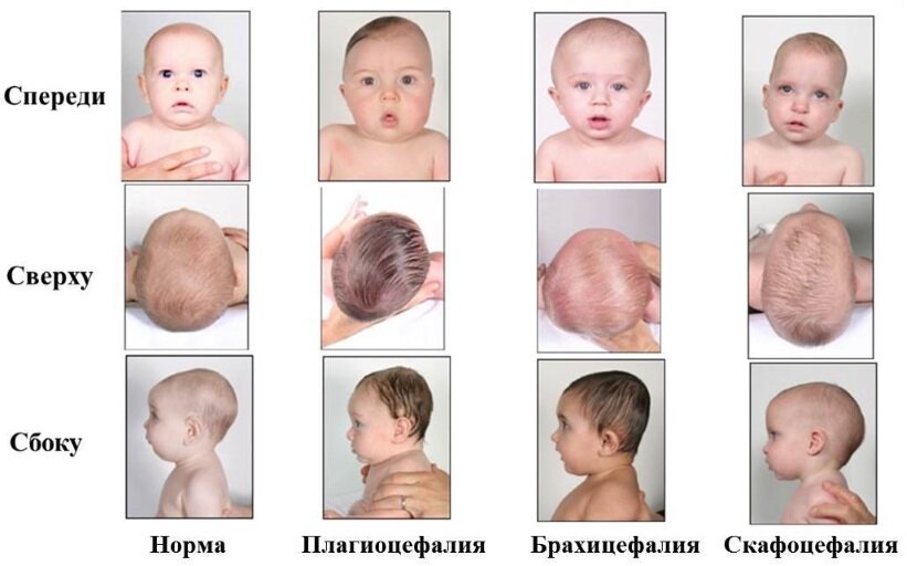 Как выглядит голова ребенка 5 явлений у новорожденного, которые могут напугать молодых родителей Родитель см