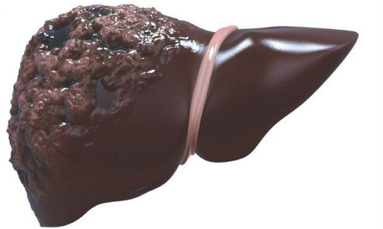 Cirrhosis