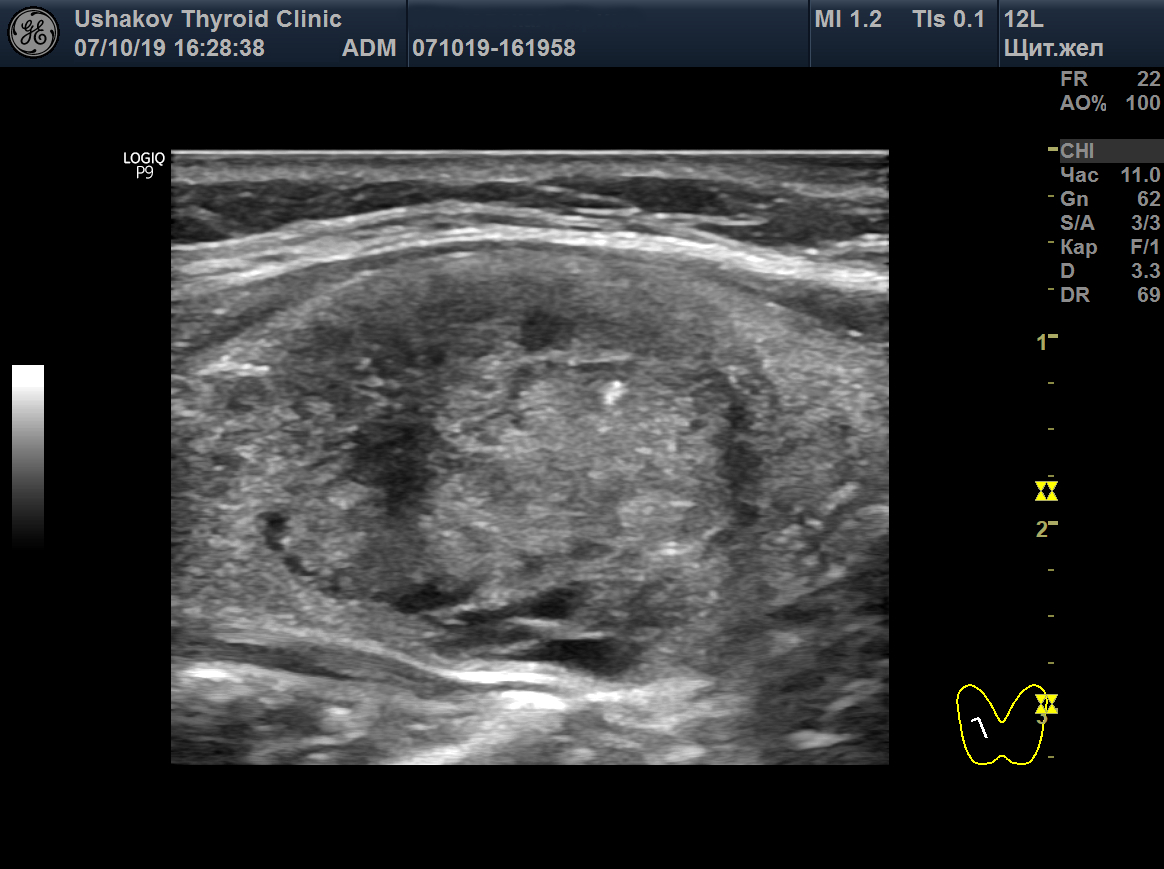 Рак щитовидной железы виден при УЗИ. Оценка рака по ACR Ti-Rads с 2017 стала лучше (из практики доктора А. В. Ушакова)