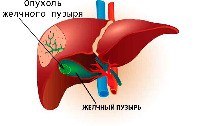 Застой в печени симптомы