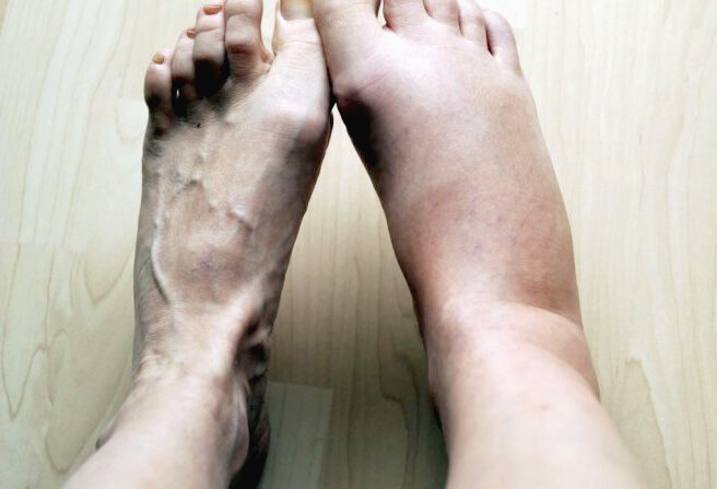 Отеки ног, рук, под глазами от лишнего кол-ва жидкости.