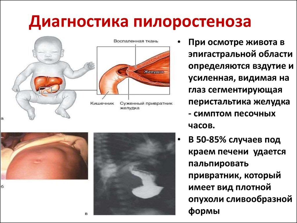 При пилороспазме клиническая картина начинается