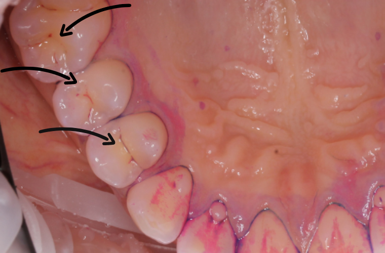 Фиссуры зубов (пациенту проведено окрашивание индикатором зубного налёта  перед сеансом профессиональной чистки зубов)