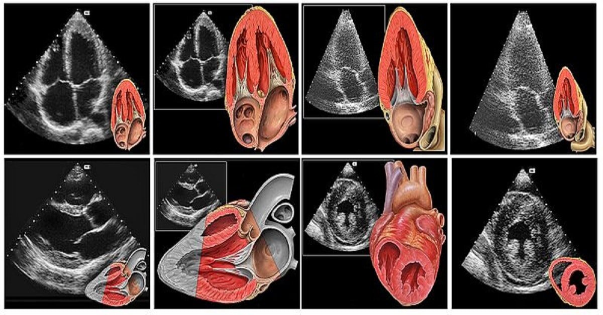 Как проходит эхокардиография сердца у женщин фото УЗИ сердца Эхокардиография Эхо-КГ Ультразвуковая диагностика в кардиологии Medna
