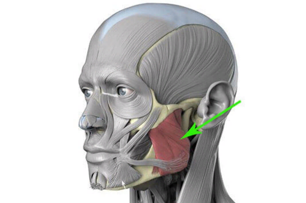 Мышцы челюсти. Жевательная мышца (m. Masseter). Мускулюс массетер. Masseter мышца. Жевательные мышцы и брыли.