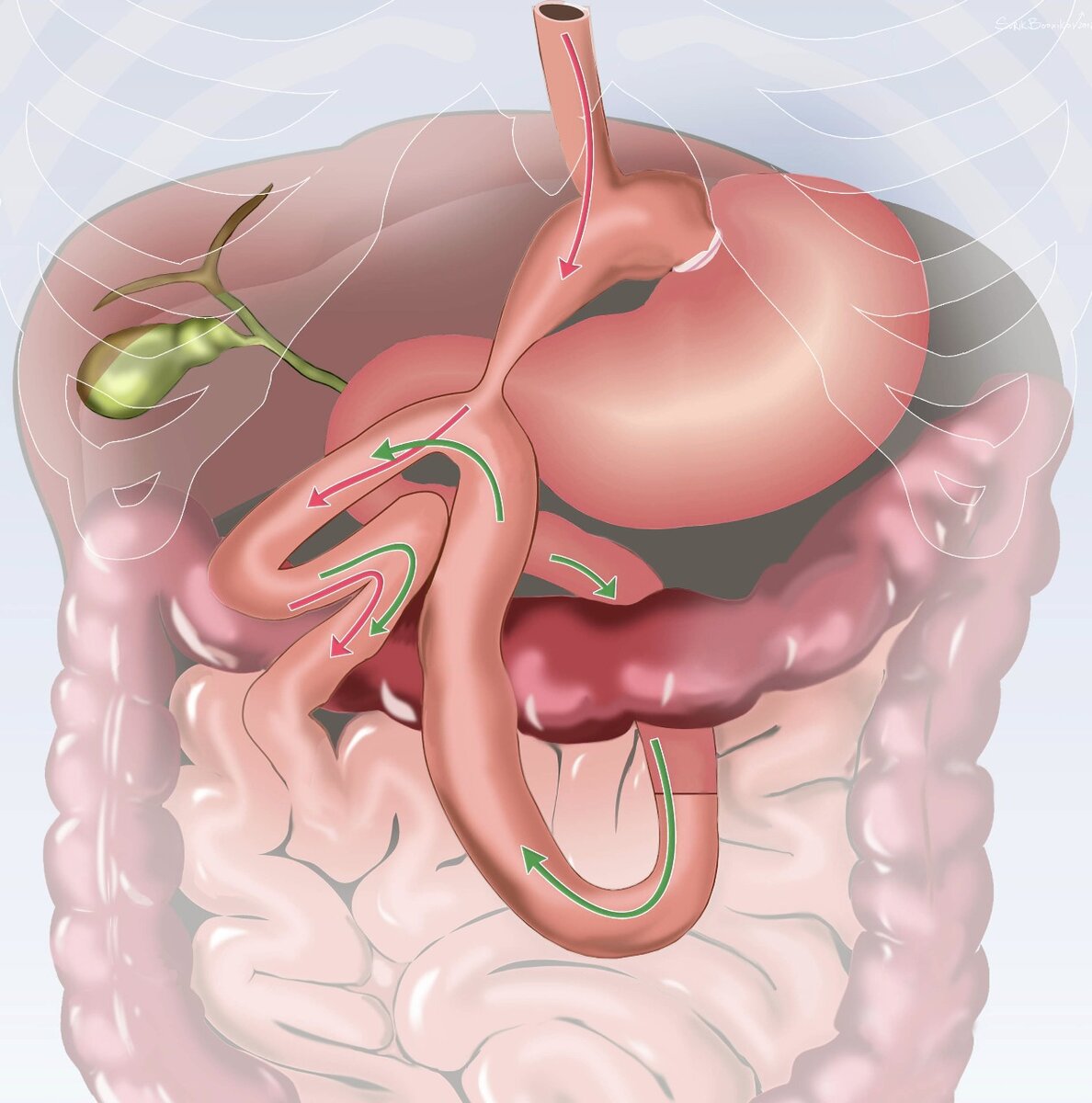 Шунтирование желудка. Билиопанкреатическое шунтирование. Лапароскопическое гастрошунтирование. Билиопанкреатическое шунтирование желудка что это. Гастрошунтирование желудка операция.