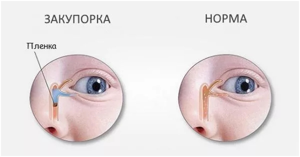 Непроходимость слезного канала