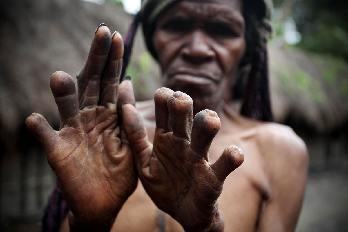 Как рожают племена. Племя Дани новая Гвинея. Отрезание пальцев в племени Дани. Племя новая Гвинея Дани Гвинея.