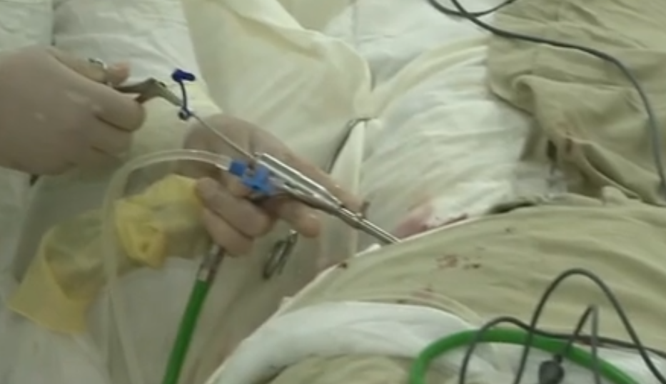 Так проходит сама процедура удаления грыжи.