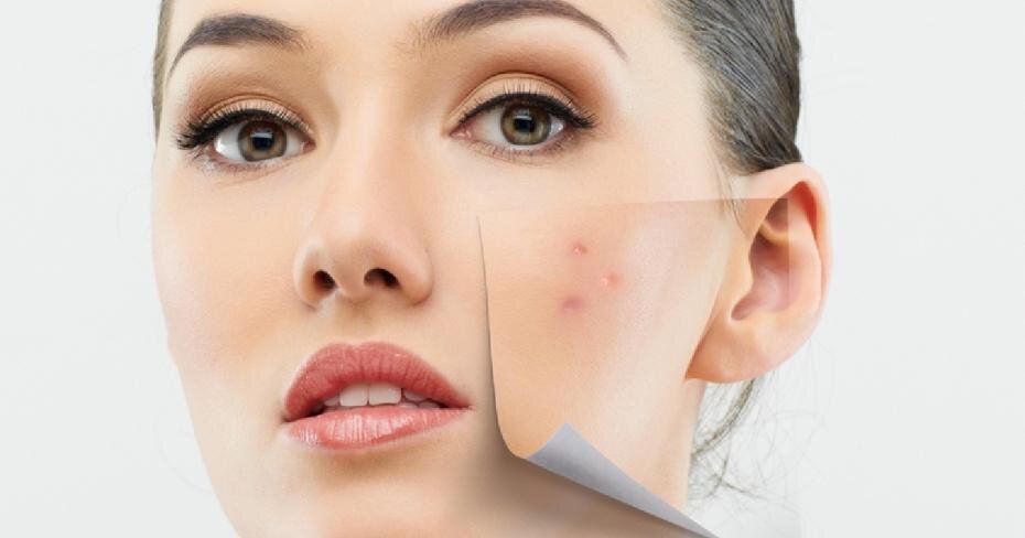 красные пятна после прыщей