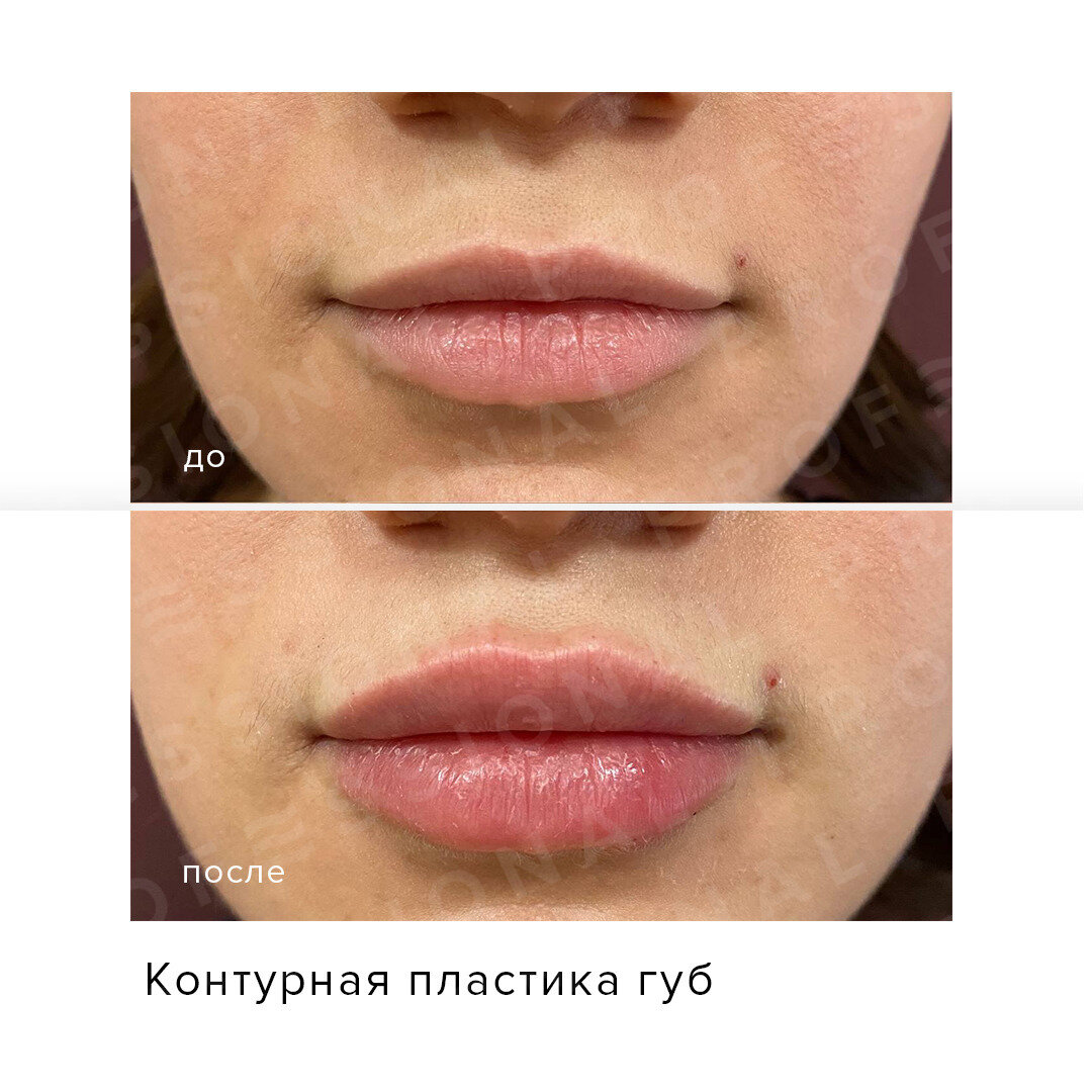 Массаж губ после увеличения когда делать можно. Контурная пластика губ до и после. Губы после контурной пластики. Контурная пластика губ фото.