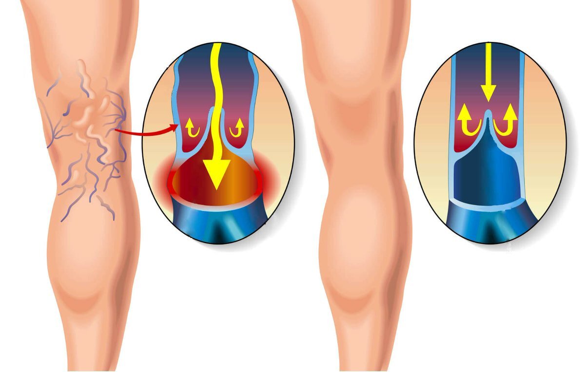 Варикозное расширение вен стопы. Варикозное расширение вен нижних конечностей анатомия. Варикозное расширение вен нижних конечностей. Стадии клинического течения варикозного расширения вен. Суральные вены голени анатомия.