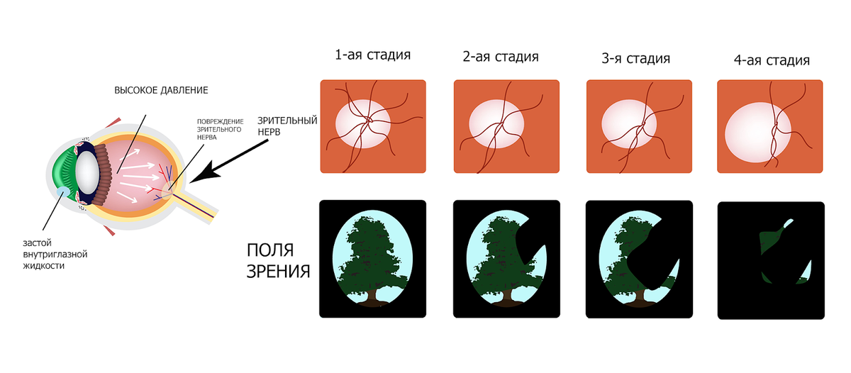 Признаки повышенного давления у пожилого человека