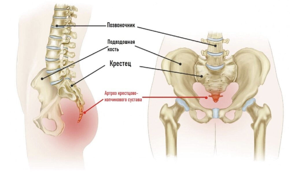 Болит копчик какие причины