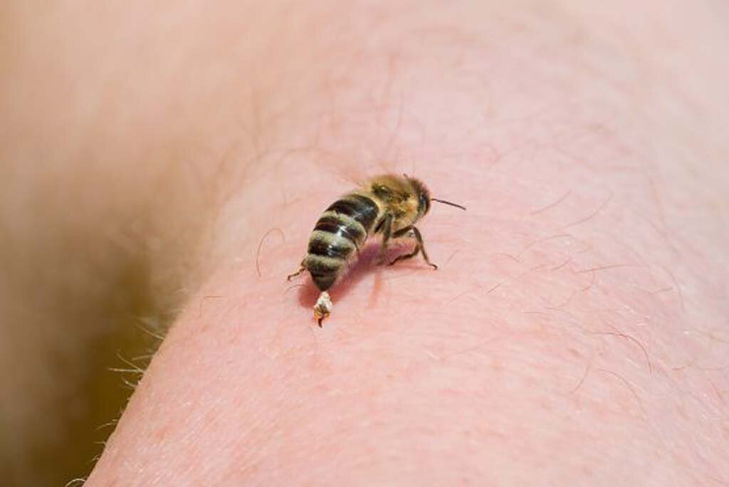Укус пчелы. Когда пчела жалит, она впрыскивает яд в кожу, вызывая боль, а у некоторых людей - аллергическую реакцию.